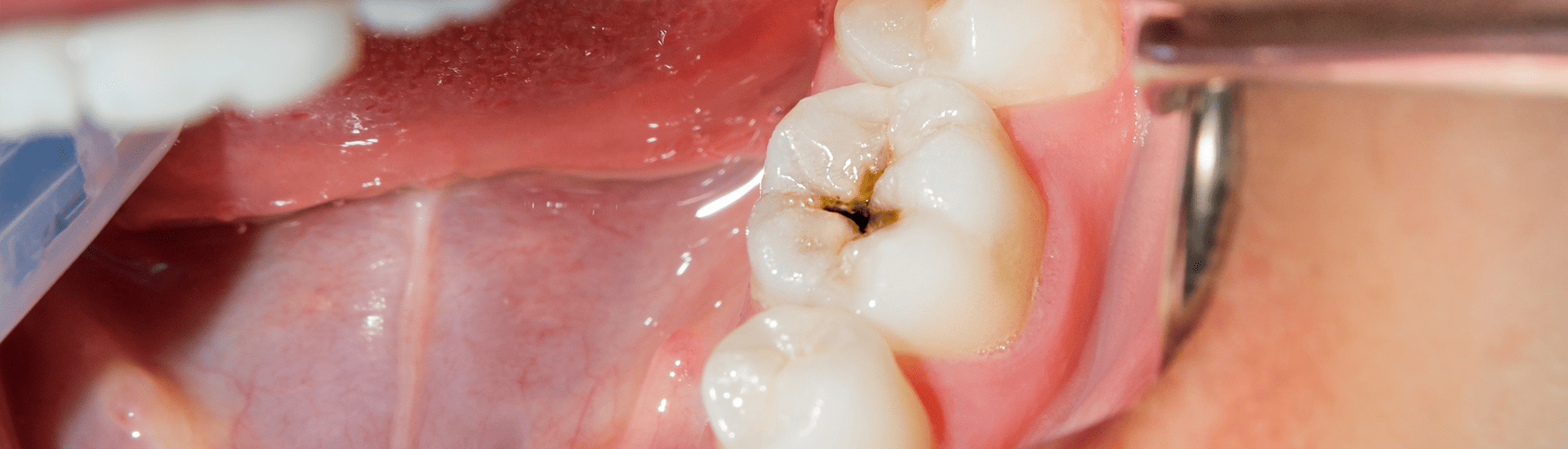 虫歯治療｜古屋歯科