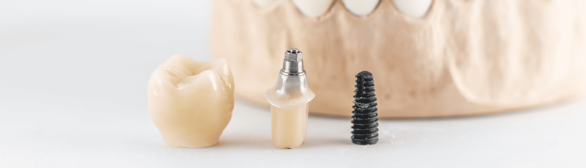 インプラント｜古屋歯科