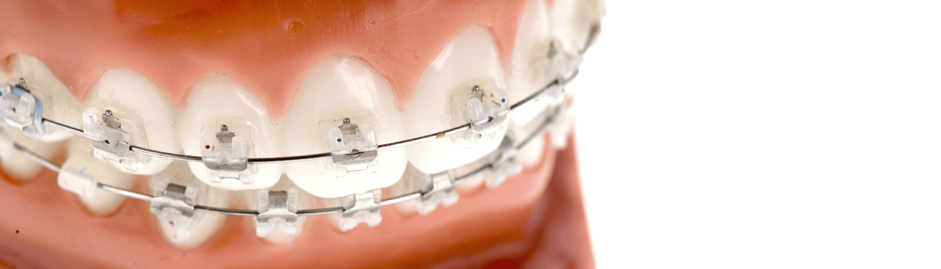 成人矯正治療｜古屋歯科