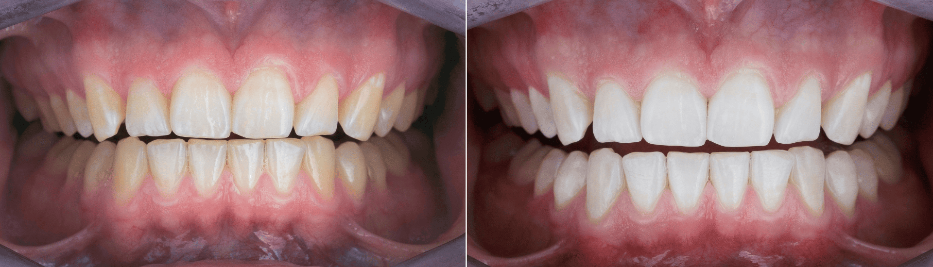 ホワイトニング｜古屋歯科