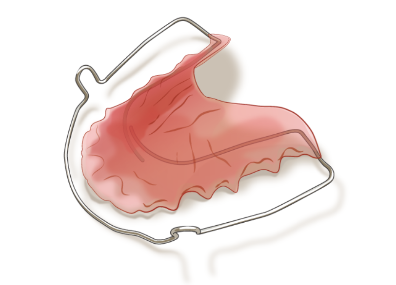 リテーナー｜古屋歯科