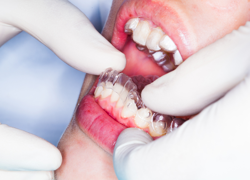 矯正装置の装着｜古屋歯科