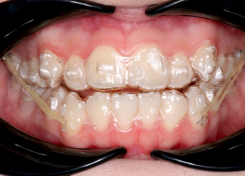 定期的な調整｜古屋歯科