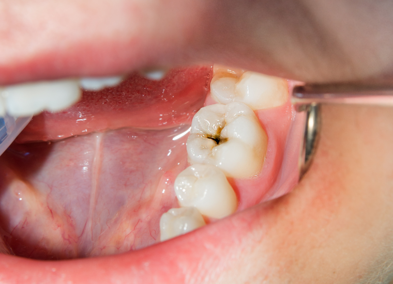 虫歯治療｜古屋歯科