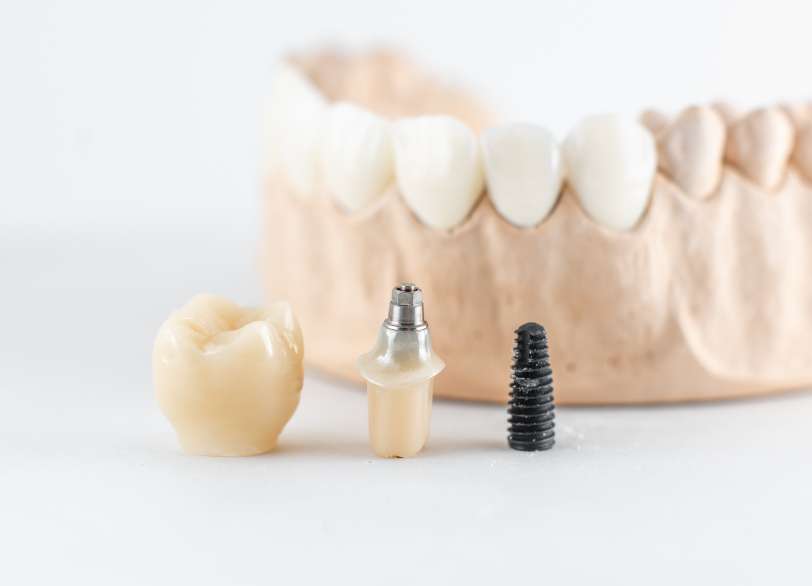 インプラント治療｜古屋歯科