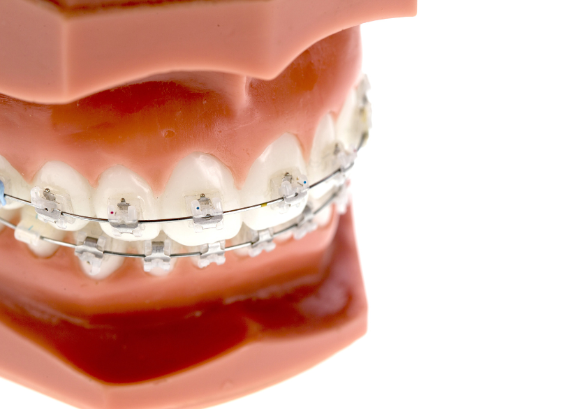 成人矯正｜古屋歯科