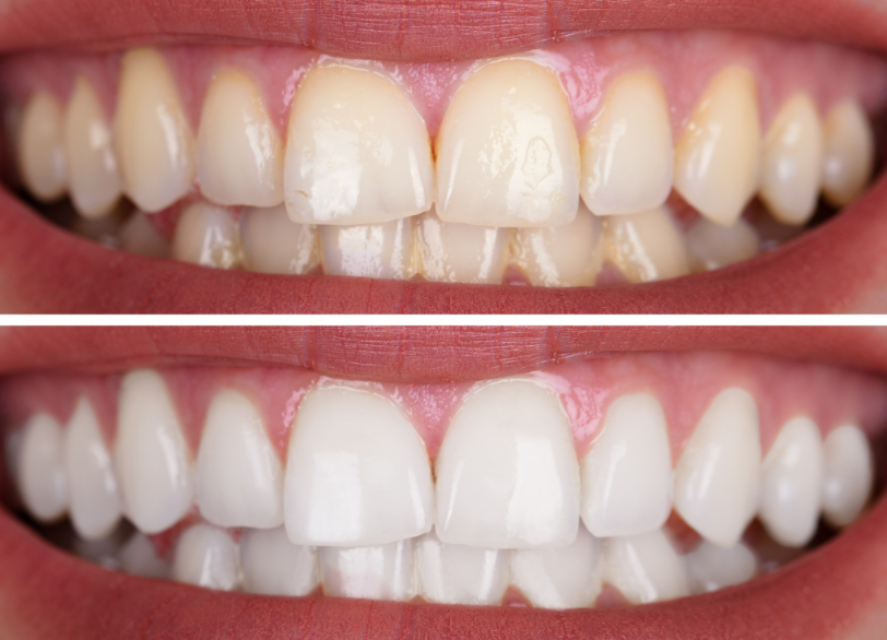 ホワイトニング｜古屋歯科