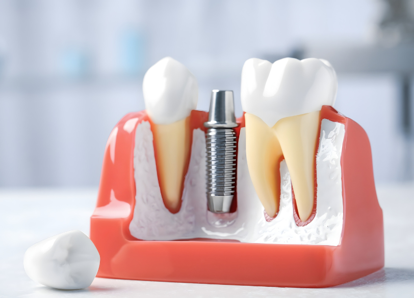 治癒期間｜古屋歯科