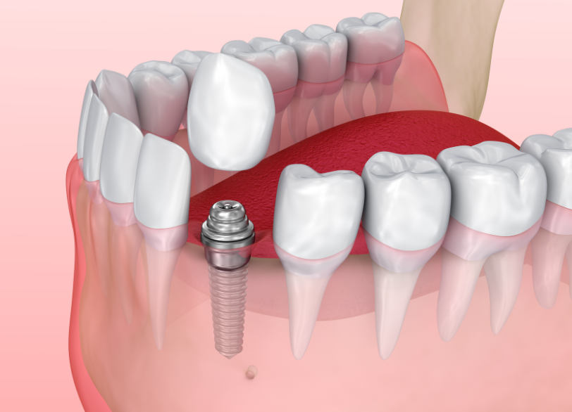 上部構造（人工歯）の製作・装着｜古屋歯科