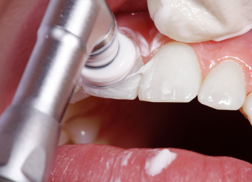 PMTC ｜古屋歯科