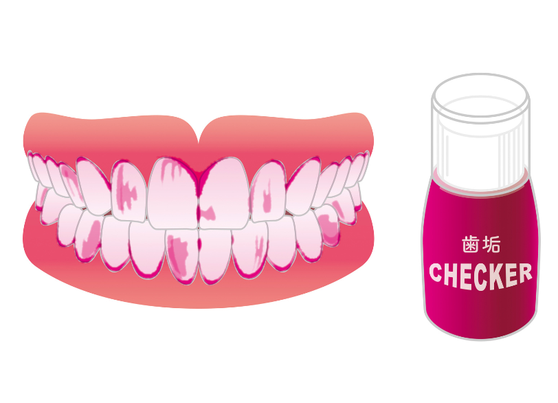 染め出し｜古屋歯科